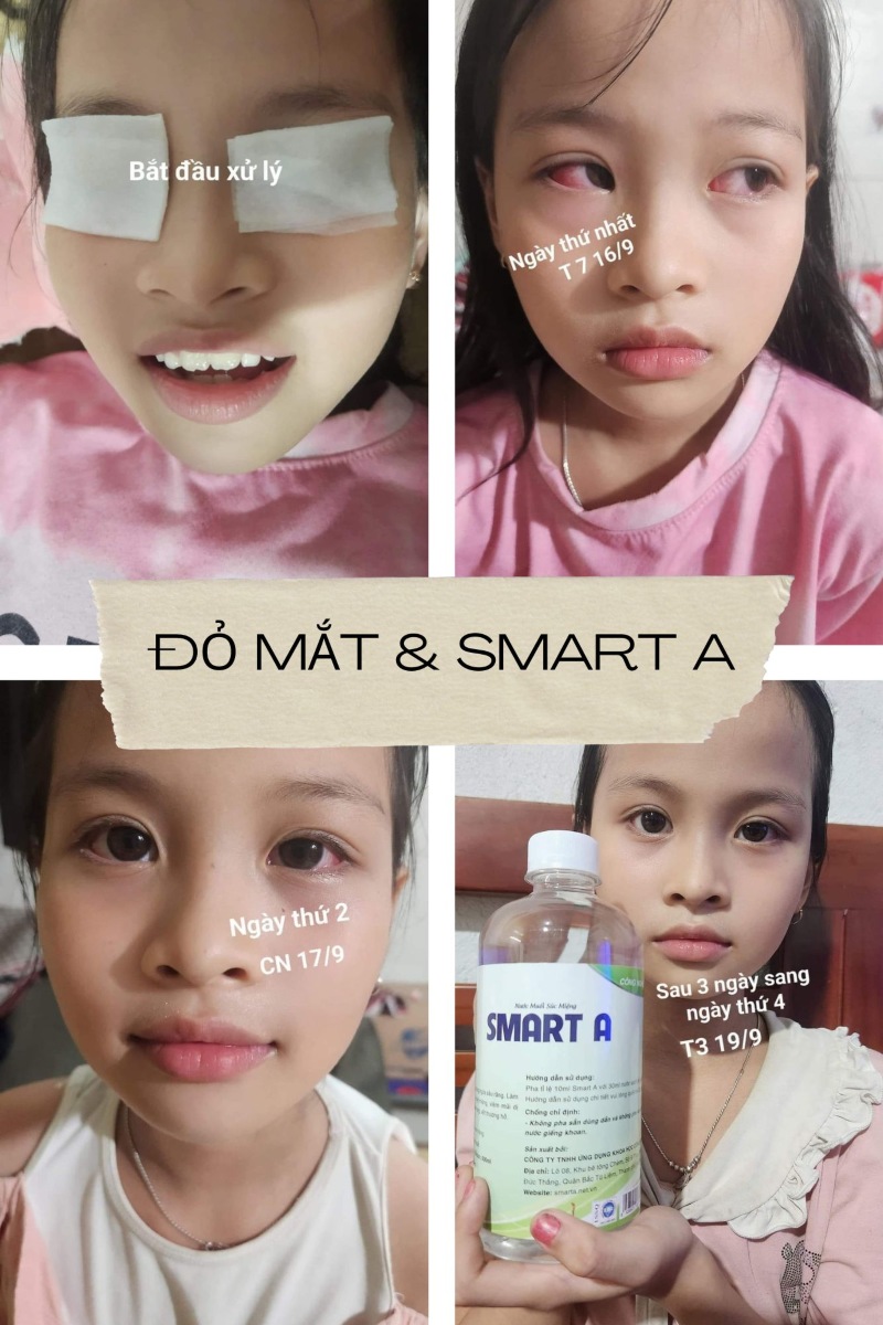 smart a nhỏ mắt được không